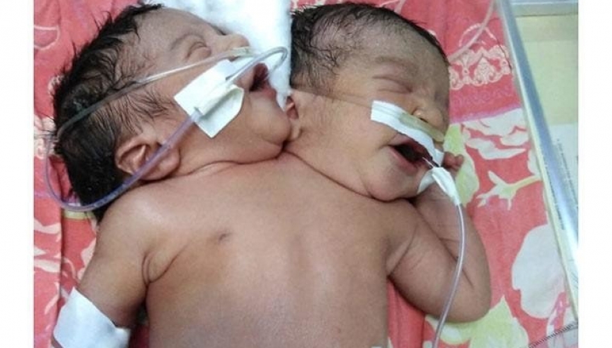 ولادة نادرة في مصر.. طفل برأسين و5 أطراف وقلب واحد!