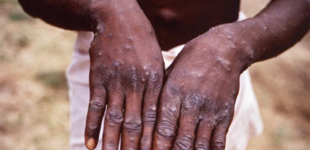 الصحة العالمية تدعو أوروبا لتحرك عاجل لمواجهة جدري القردة قبل تحولها لبؤرة لانتشار المرض