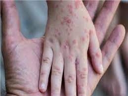 أستراليا تسجل 44 إصابة بجدري القردة