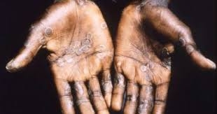 الهند تسجل إصابة أول أمرأة بجدري القردة