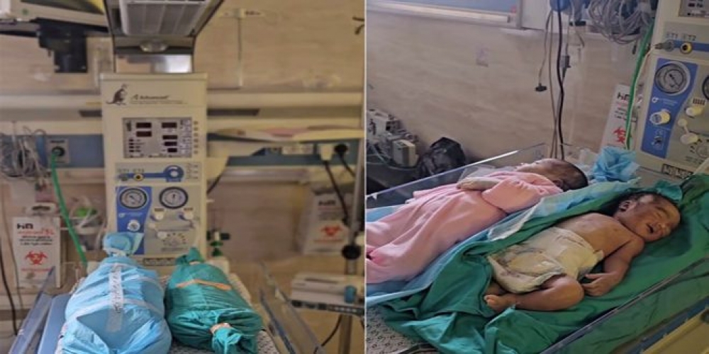 ارتفاع عدد الأطفال المتوفين جراء سوء التغذية في قطاع غزة إلى 16