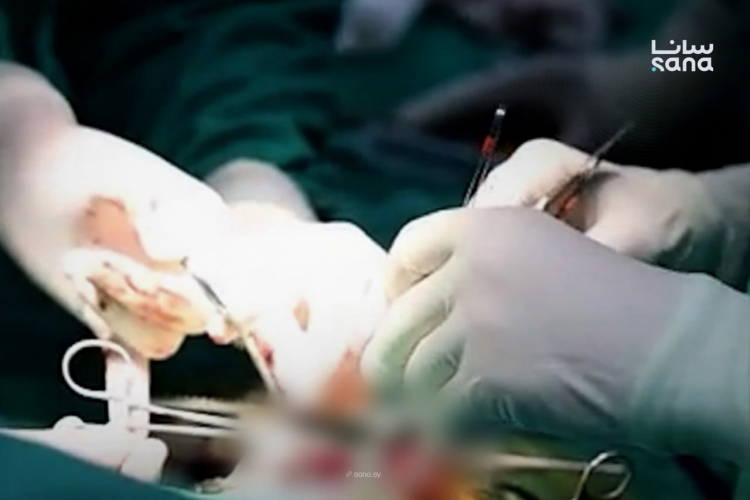 مشفى جراحة القلب الجامعي بدمشق ينجح في علاج تشوهات القلب الولادية بتقنية جديدة