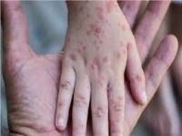 أستراليا تسجل 44 إصابة بجدري القردة